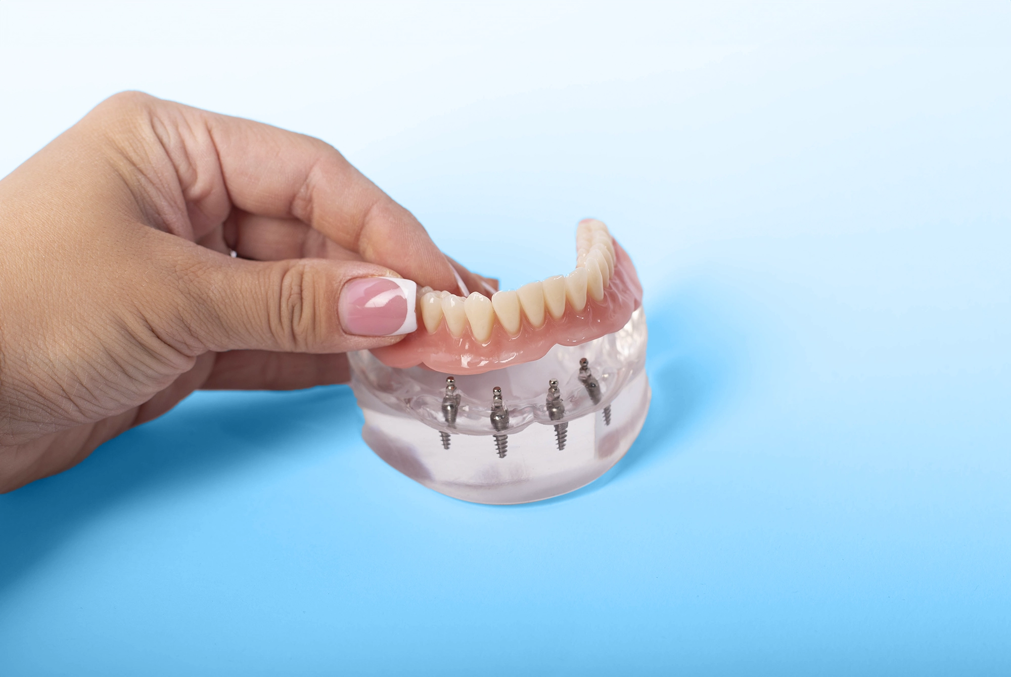 dental implants