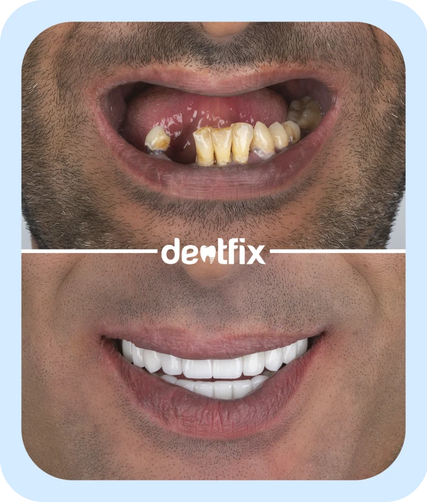 implant-dentures-1