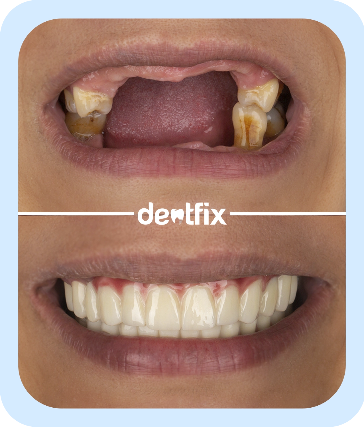 implant-dentures-3