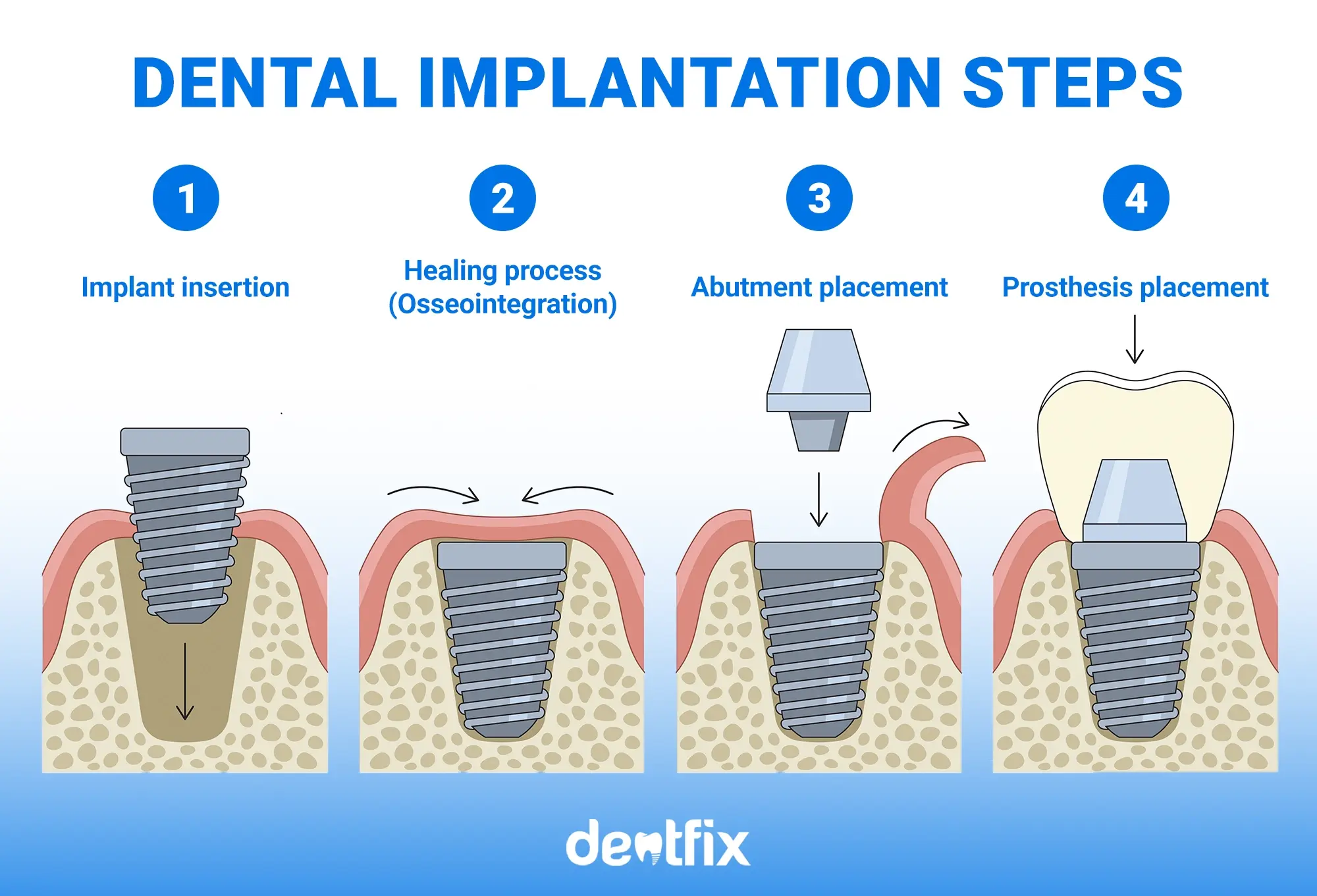 dental implants steps