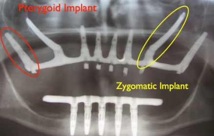 zygomatic implants