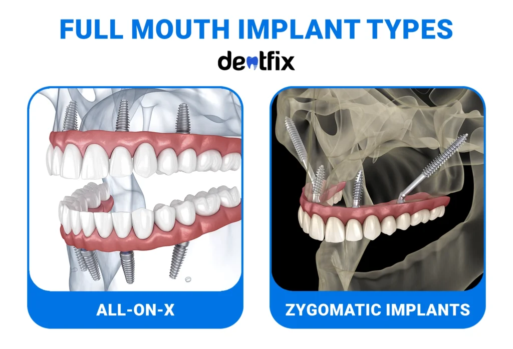 FULL MOUTH IMPLANT TYPES