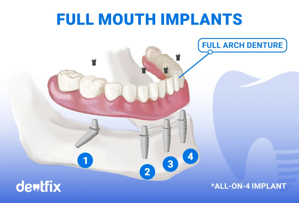 FULL MOUTH IMPLANTS