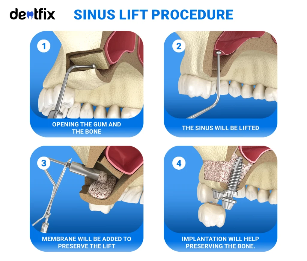 Sinus Lift Procedure